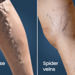 Varicose veins (or spider veins) are swollen